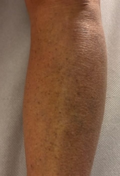 Varicosités des jambes après traitement